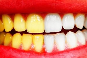 10 способов отбеливания зубов