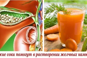 Травы для растворения камней в желчном пузыре