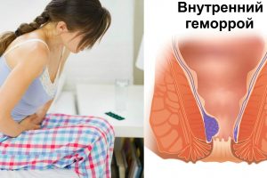 Популярные методы лечения геморроя