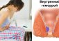 Популярные методы лечения геморроя